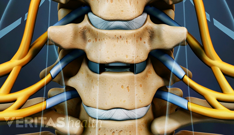 Anterior view of cervical spine showing artificial disc inserted.