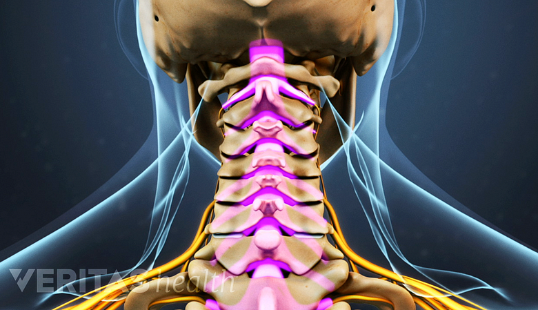 Posterior view of the cervical spine highlighting spinal stenosis.