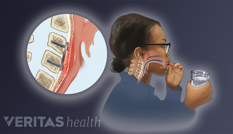 Illustration showing difficulty in swallowing.