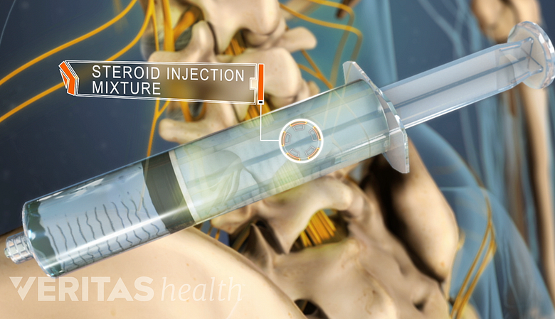 Steroid injection mixture in a syringe in front of lumbar spine.
