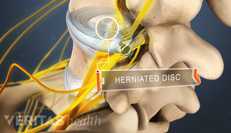 Posterior view labeling a herniated disc in the lumbar spine.