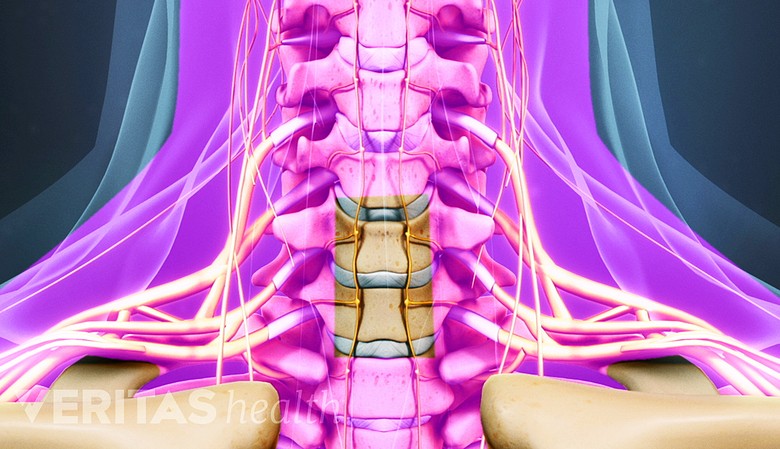 Medical illustration showing the incision point for a cervical foraminal stenosis surgery