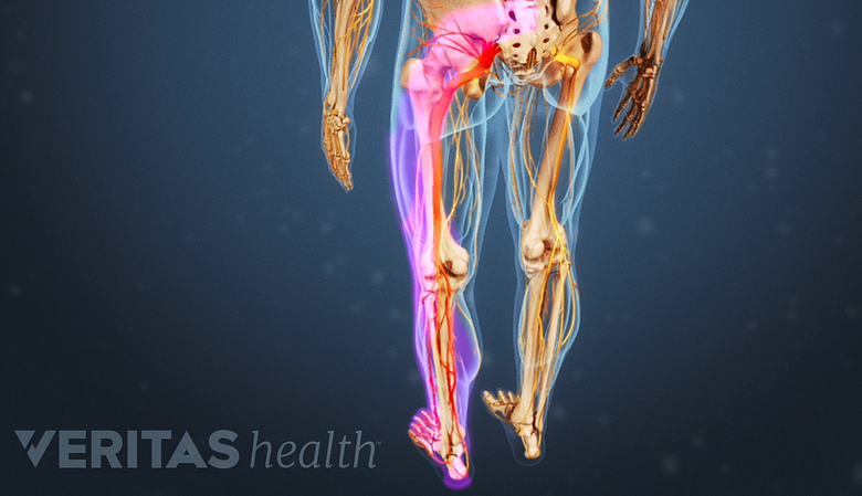 Medical illustration of a skeleton with the sciatic nerve highlighted in red indicating pain, numbness or tingling.