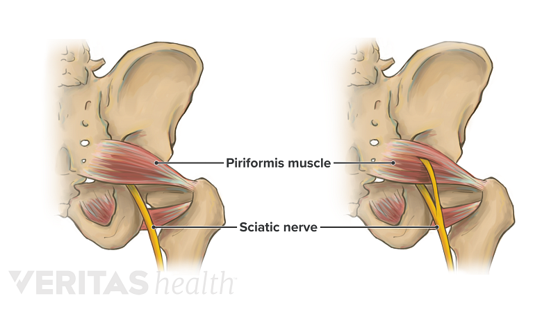 The left side of two pelvises showing the anatomic variation of the sciatic nerve as it courses below the piriformis muscle and through the piriformis muscle.
